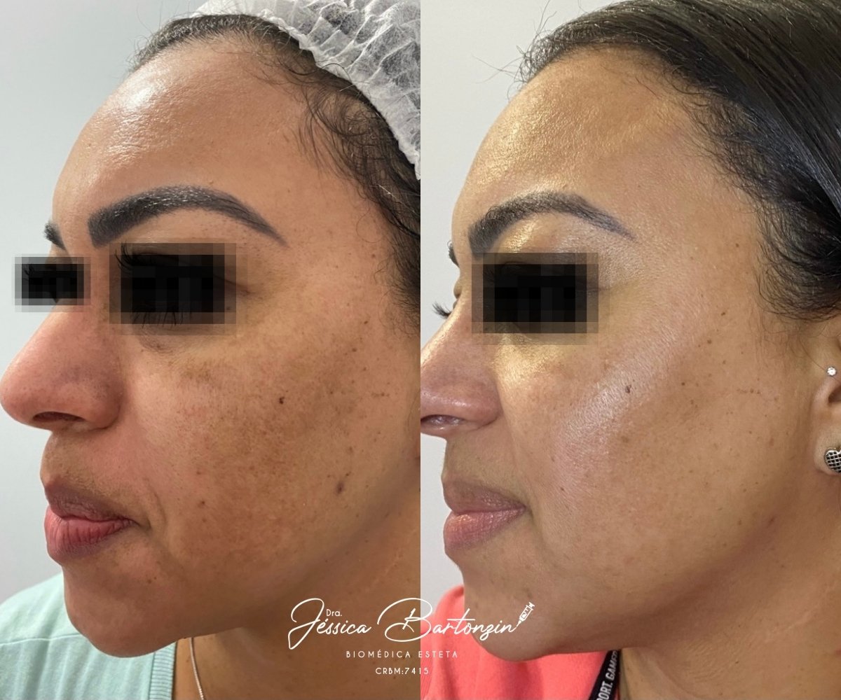 Melasma (7)