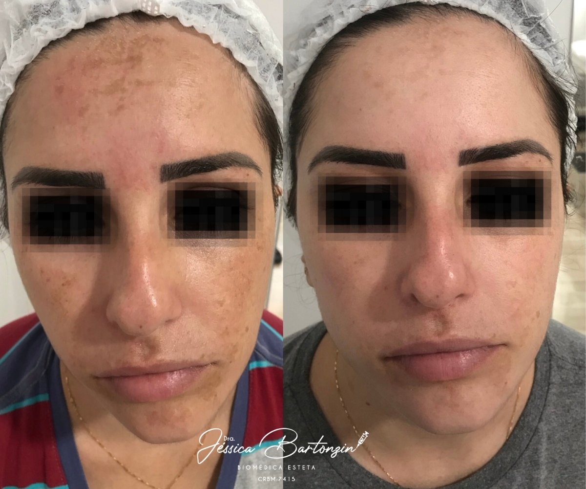 Melasma